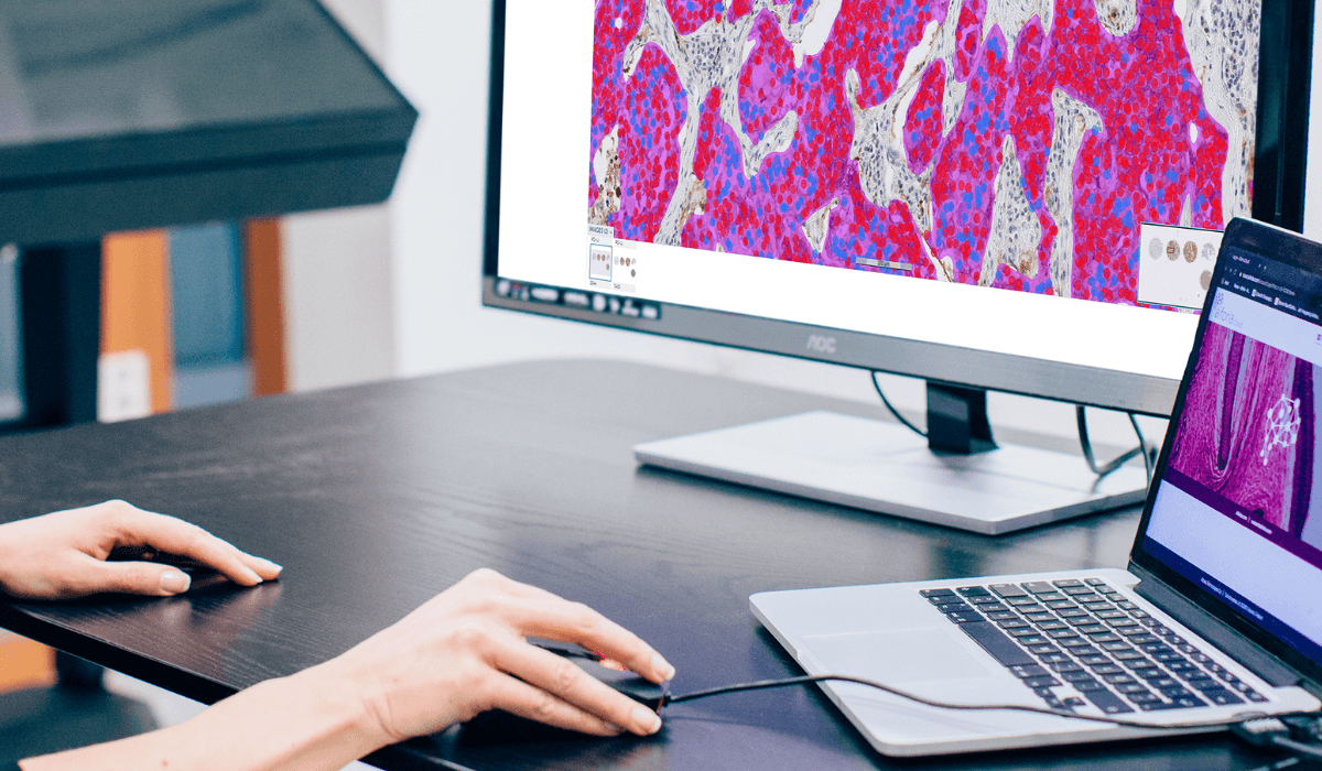 Case study enhancing mesothelioma research with AI